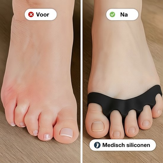 Alyze Toe Spread Silicon - 2 Stück - Hallux Valgus Corrector - Zehenschutz - Zehenspreizer - Zehenkorrektur - Hammer Toe Brace - Big Toe - Personal Care