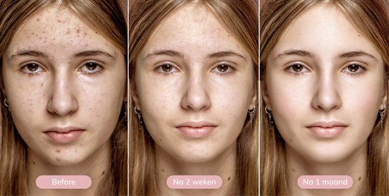 Vimora Mitesser-Entferner - Gesichtsreiniger - Mitesser-Entferner - Pickel-Entfernung - Gesichtsreiniger - Pflege Männer & Frauen - Akne & Pickel - Gesichtspflege-Set - Pure Cleanser