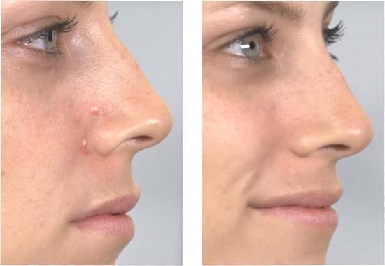 Derma Suction – Tiefenreinigung der Haut und der Poren, Entfernung von Mitessern, Mitesserentferner, Gesichtsreiniger, elektrisch, Porenreiniger