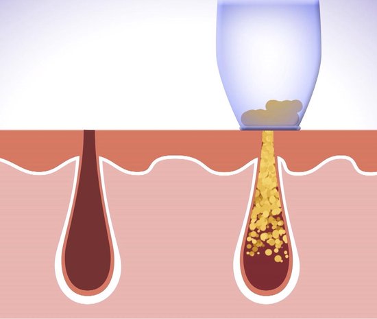 Derma Suction – Tiefenreinigung der Haut und der Poren, Entfernung von Mitessern, Mitesserentferner, Gesichtsreiniger, elektrisch, Porenreiniger