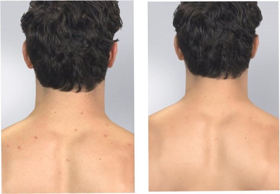 Derma Suction – Tiefenreinigung der Haut und der Poren, Entfernung von Mitessern, Mitesserentferner, Gesichtsreiniger, elektrisch, Porenreiniger