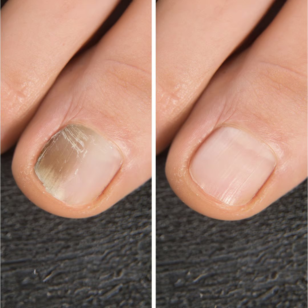 IZA Effect Fußpilz- und Nagelspray-Set – Schnelle Anwendung – Sichtbares Ergebnis – 1+1 gratis